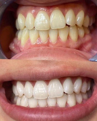 albire-dentara-bucuresti