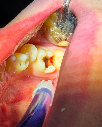 carii dentare