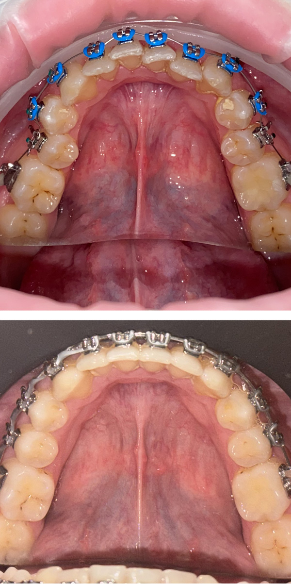 aparat dentar bucuresti