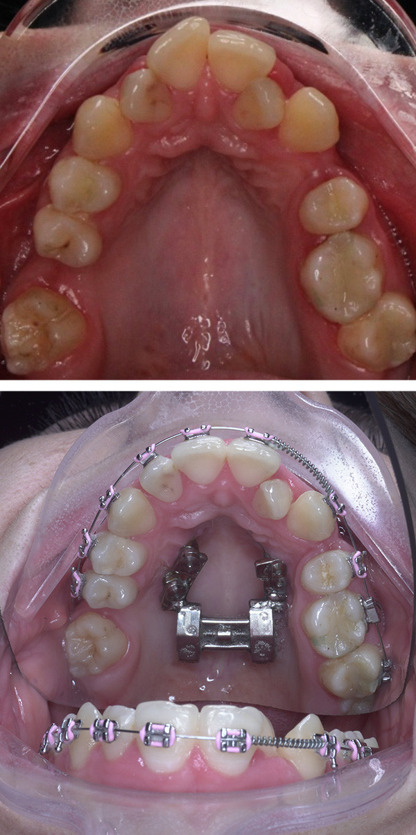 aparat dentar clinica bucuresti