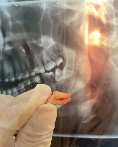 extractie molar de minte