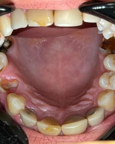durere carii dentare