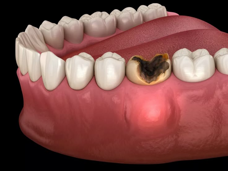 abces dentar - clinica stomatologie