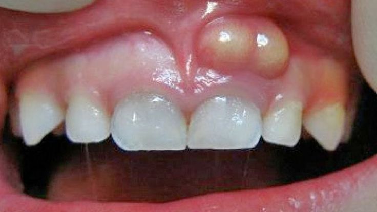 abces dentar - tratament abces