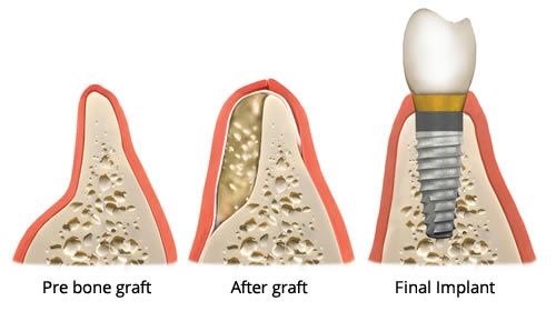 aditie-de-os-sinus-lift