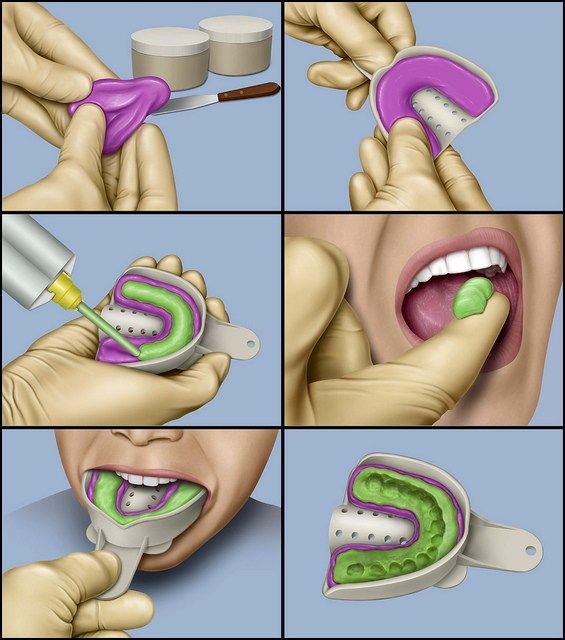 amprenta dentara clasica