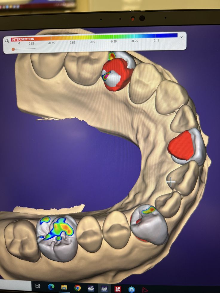 amprenta dentara digitala - clinica stomatologica ht smile
