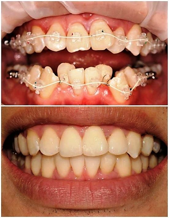 aparat-dentar-bucuresti