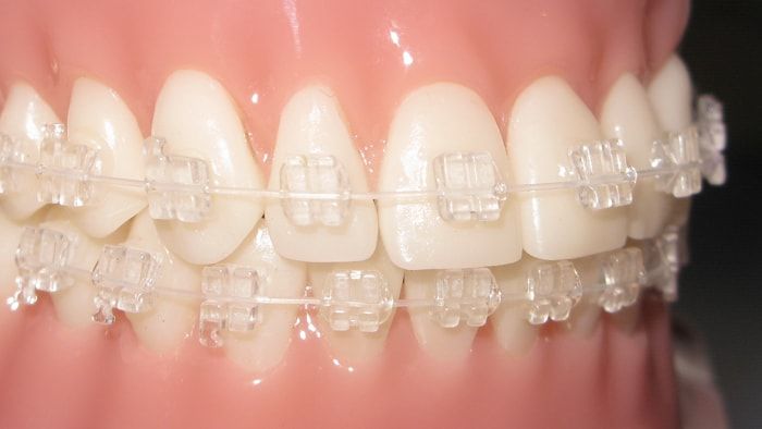 aparat-dentar-ceramic-safir