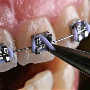 aparat-dentar-clasic-2