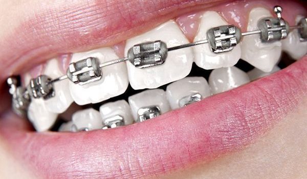 aparat-dentar-clasic
