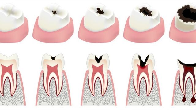 caria dentara de smalt