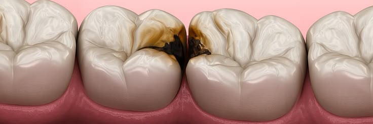 caria dentara - cauza tratament si preventie