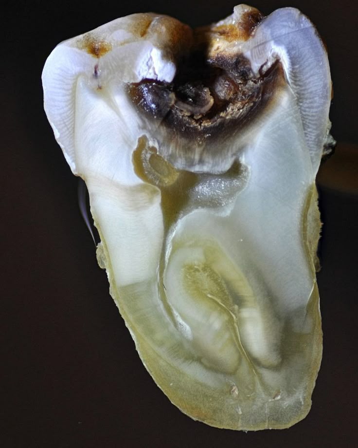 carie dentara agravata