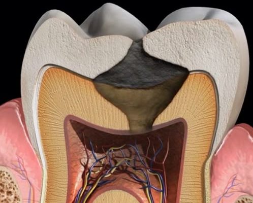 carie dentara clinica stomatologica