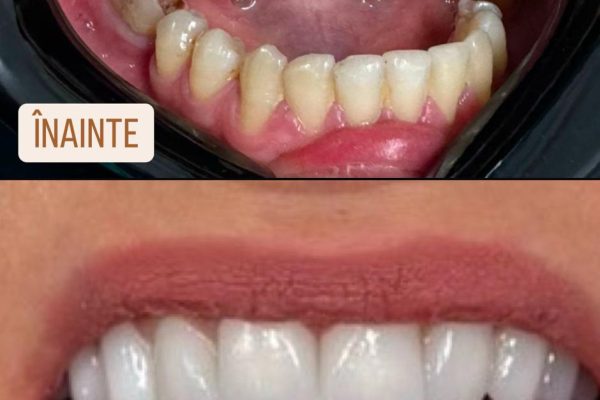 Reabilitare orala totala – cazul 02