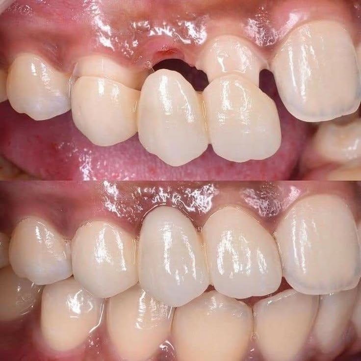 ce este o punte dentara