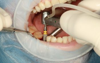 chirurgie-orala-sistem-all-on-four-six