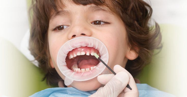 de ce este importanta fluorizarea dentara