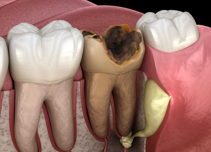 drenaj endodontic - tratament abces dentar