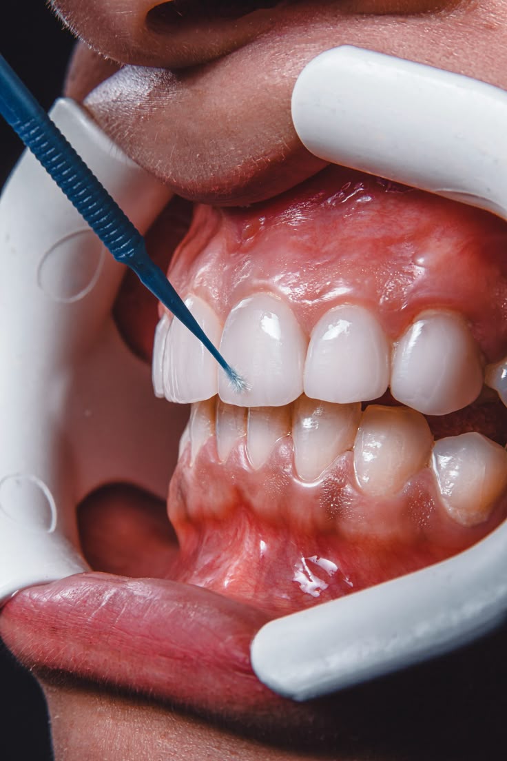 fluorizare dentara profesionala bucuresti