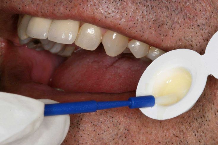 fluorizare dentara profesionala