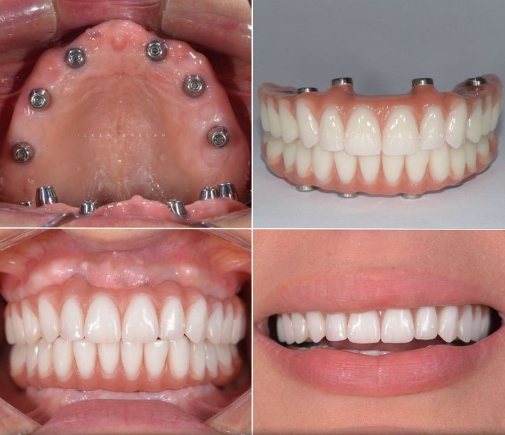 implant-dentar-bucuresti