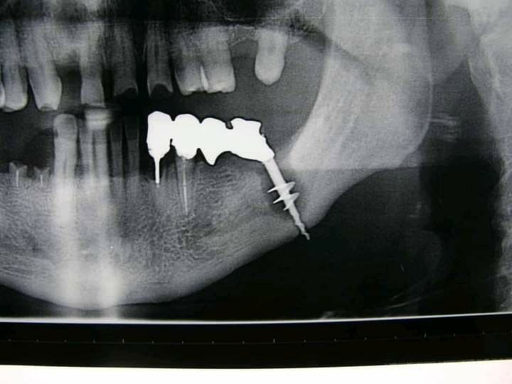 indepartare instrument fracturat