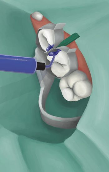 indepartare tesut cariat