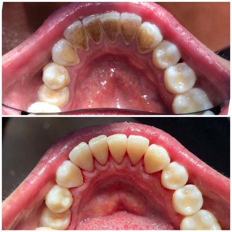 inlaturare-tartru-detartraj-dentar