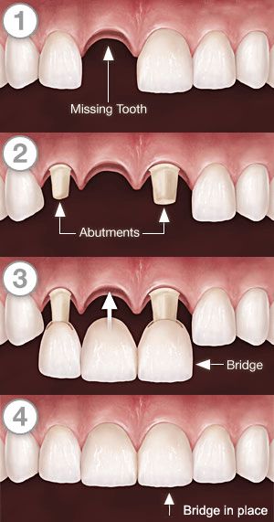 pregatire pentru punte dentara