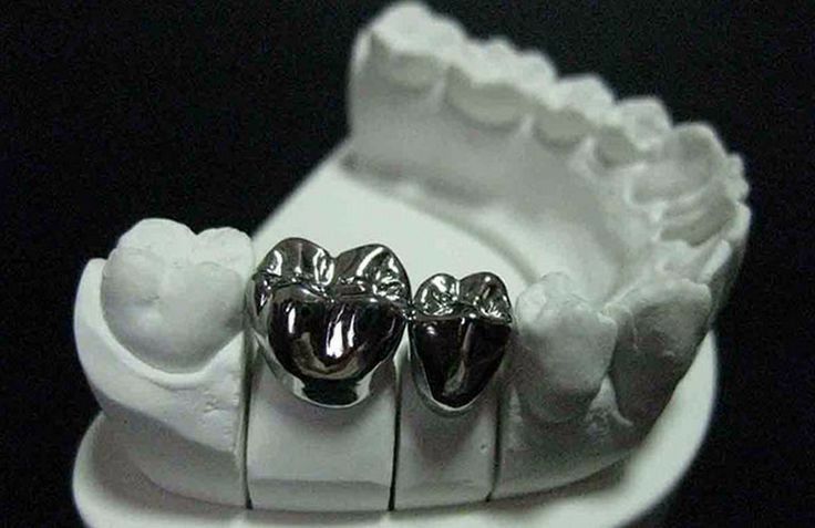 punte ceramica vs metalo ceramica
