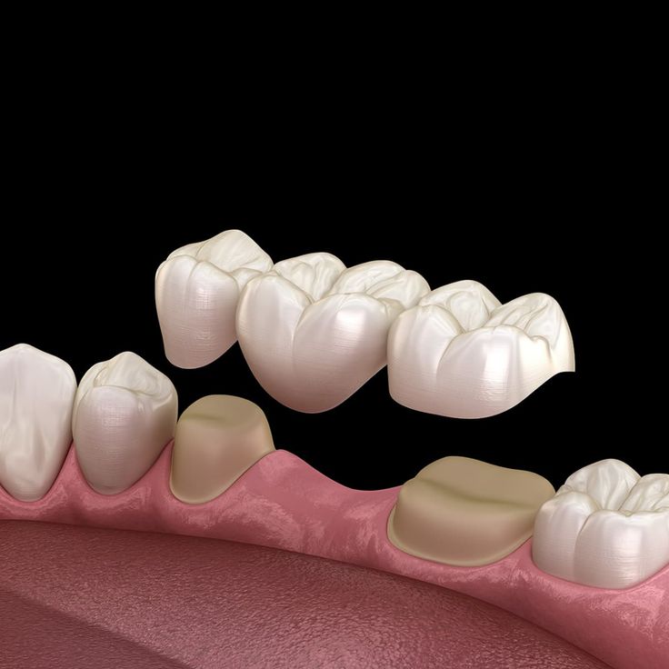 punte-dentara