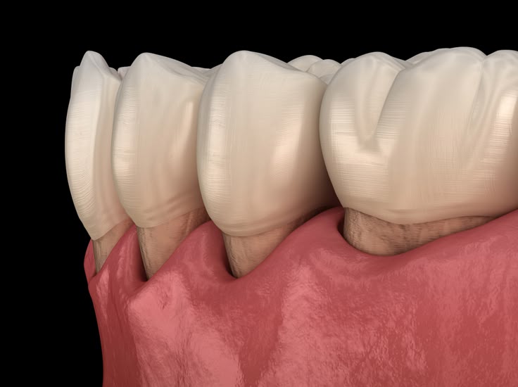 retragerea-gingiilor-boala-parodontala