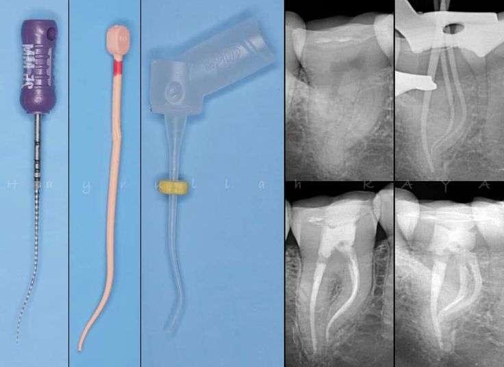 retratament endodontic de canal clinica stoma
