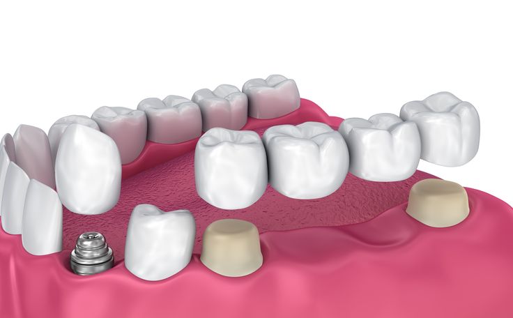 sfaturi si indicatii punte dentara