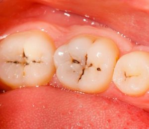 sigilzari dentare copii