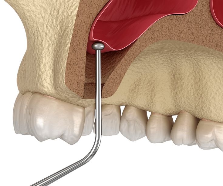 sinus-lift-bucuresti