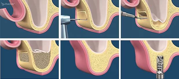 sinus-lift-extern-deschis-clinica-dentara