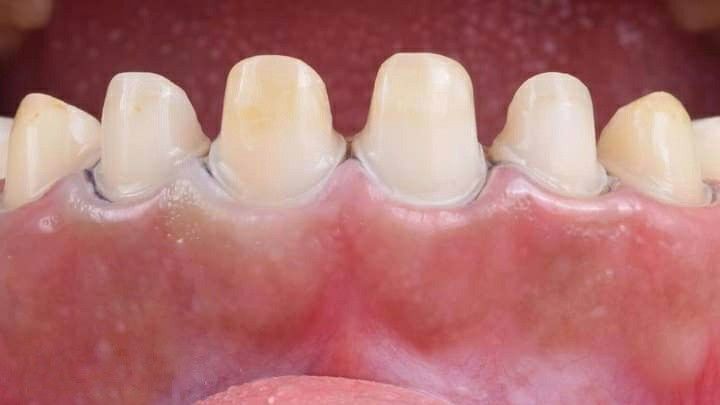 slefuire pentru coroane dentare