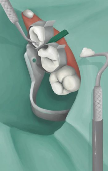 umplere cavitate carie dentara