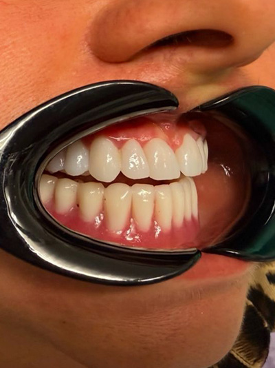 caz reabilitare orala clinica HTSmile 2025 after