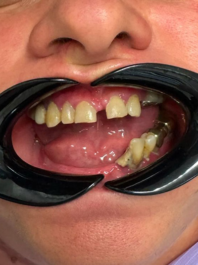 caz reabilitare orala clinica HTSmile 2025 before