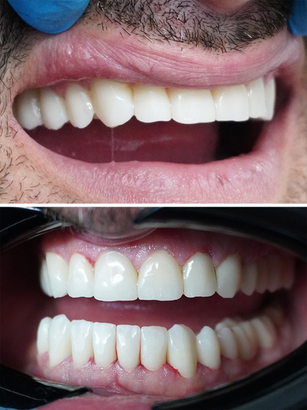 caz reabilitare orala dentara totala - august 2025 - dupa 3