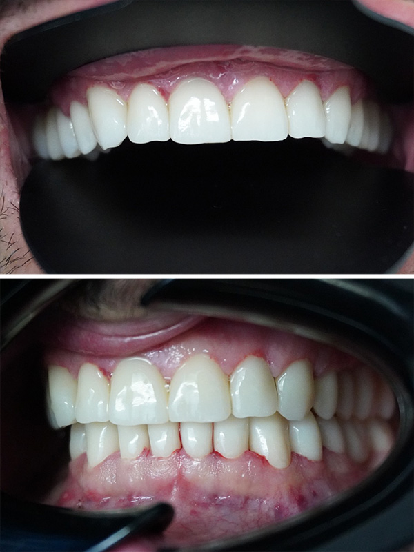 caz reabilitare orala dentara totala - august 2025 - dupa 4