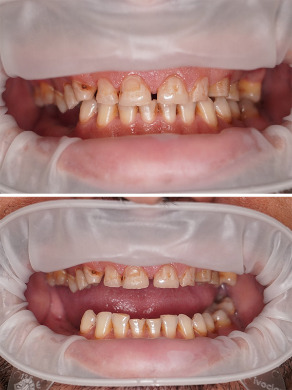 caz reabilitare orala dentara totala - august 2025 - inainte 3