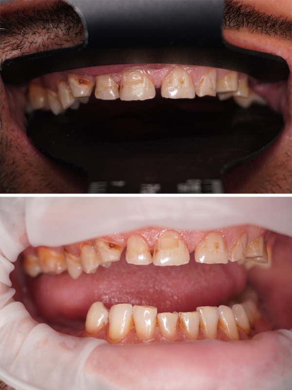 caz reabilitare orala dentara totala - august 2025 - inainte 4