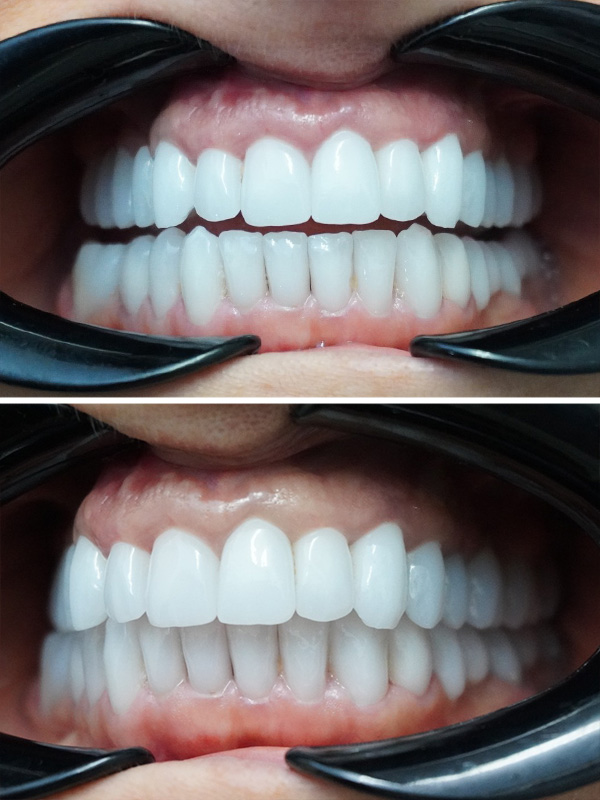 reabilitare-totala-orala-dentist-stomatolog-after2