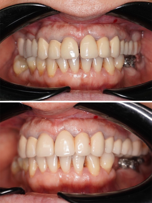 reabilitare-totala-orala-dentist-stomatolog-before2