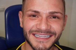 Dinti lucrare fixa